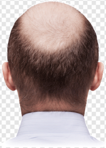 Bald Head PNG Transparent Images Download